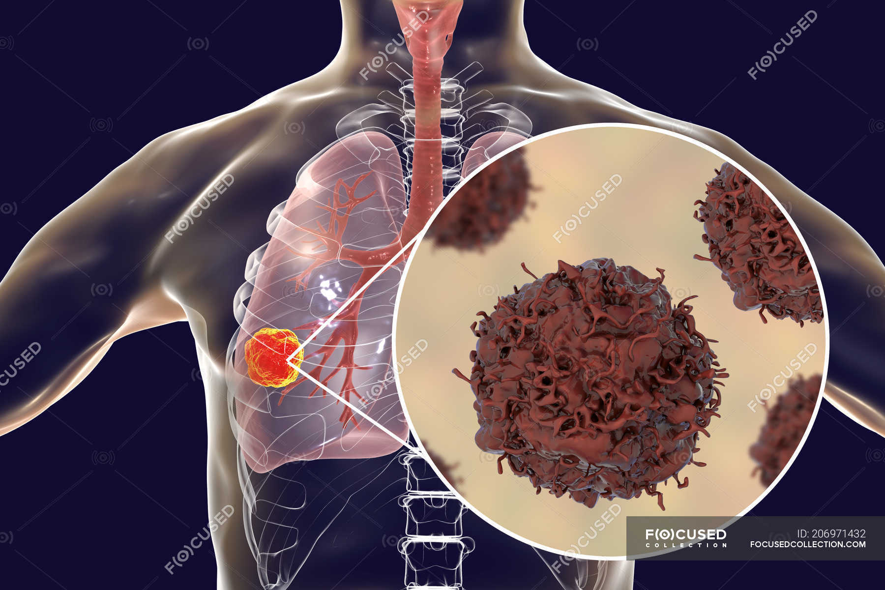 Digital Illustration Of Cancerous Tumor In Lungs And Close Up Of Lung