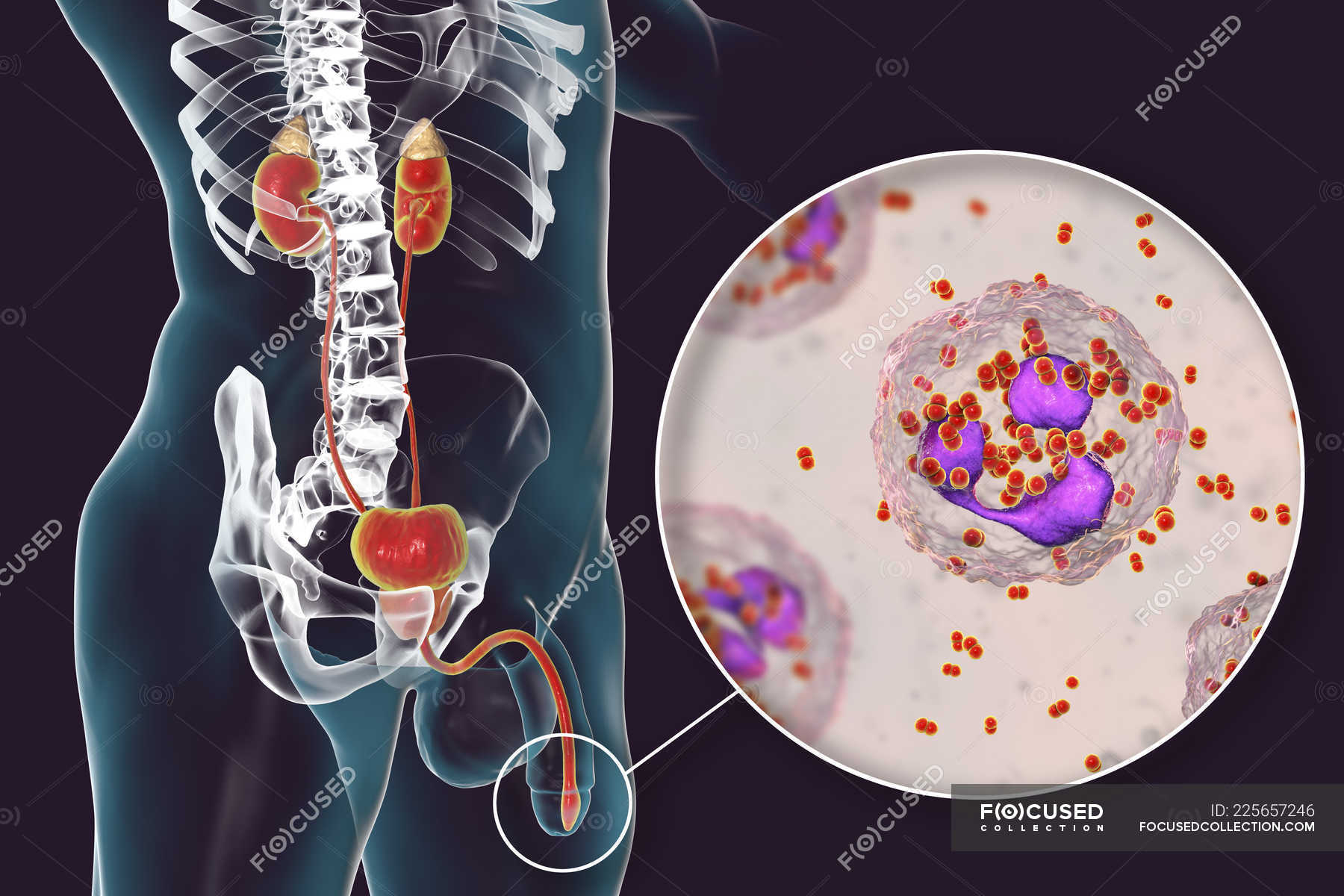 Primer Plano De La Infecci N Por Gonorrea Bacteriana En El Cuerpo