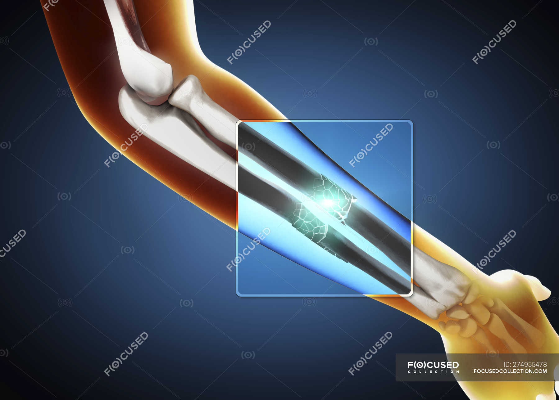 D Illustration Of X Ray Of Broken Ulna And Radius Bone Pain Technology Stock Photo