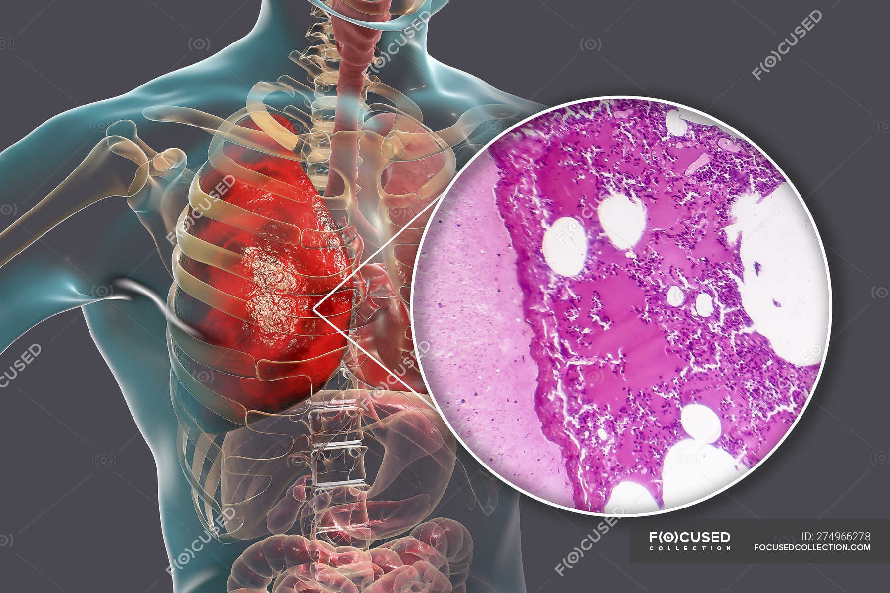 Lobar Pneumonia In Stage Of Congestion And Consolidation Digital