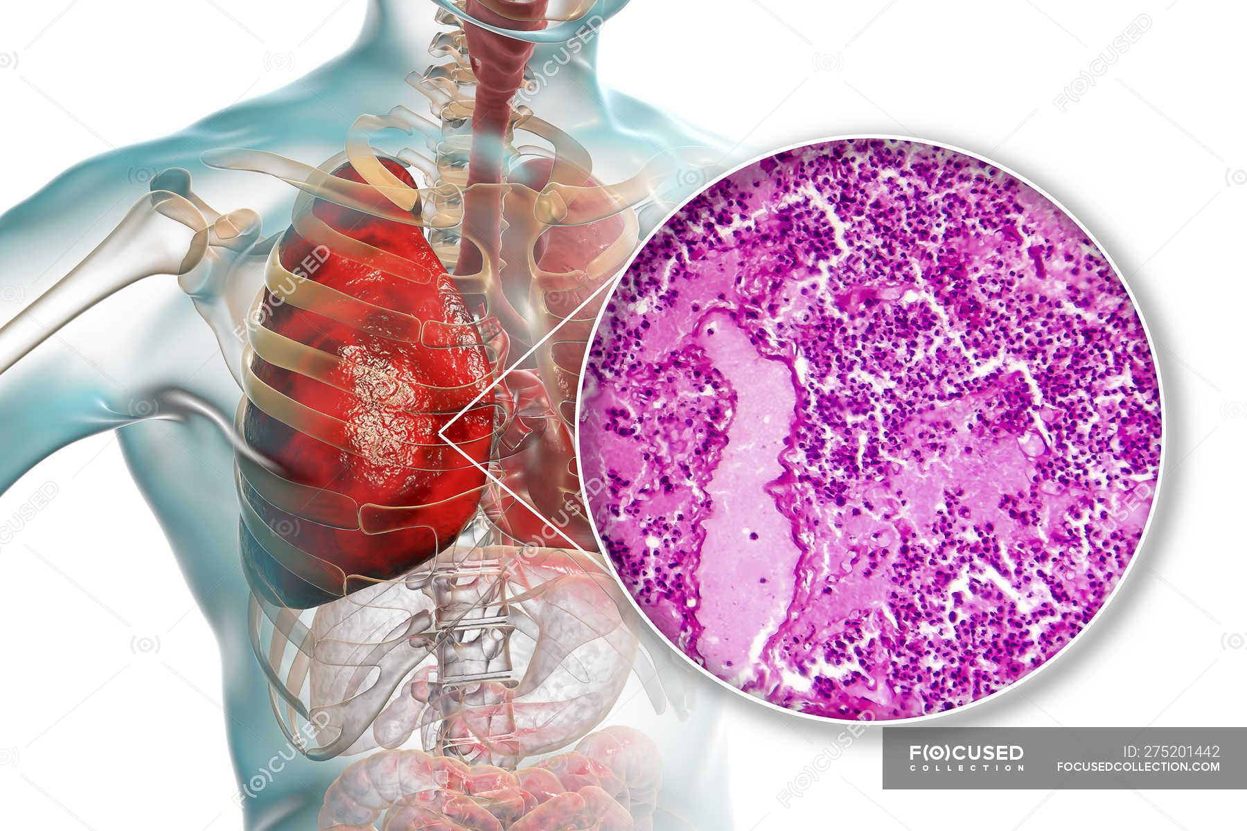 Lobar Pneumonia In Stage Of Congestion And Consolidation Digital