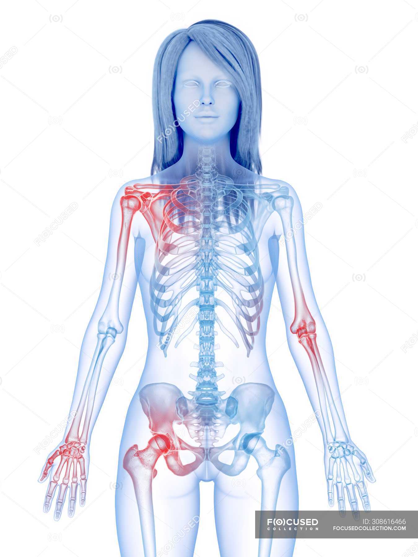 Painful Joints In Female Body Conceptual Illustration Transparent