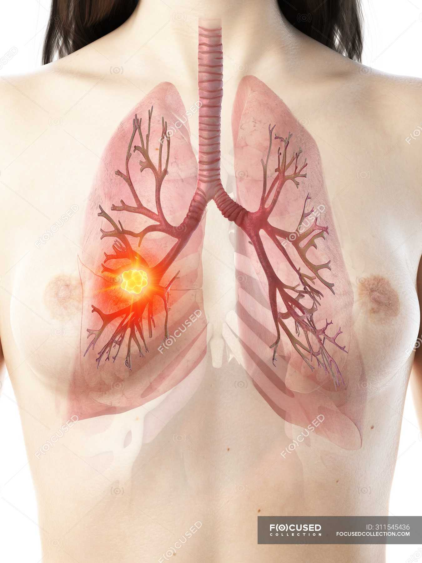 Lung Cancer In Female Realistic Body D Model Conceptual Computer