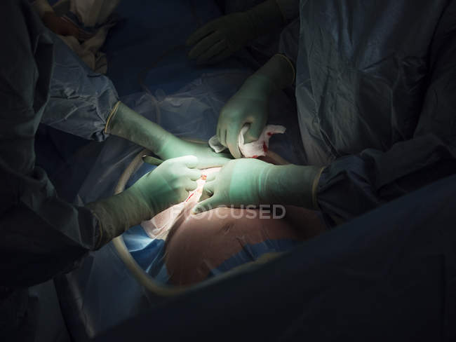 Chirurghi che eseguono taglio cesareo — Foto stock
