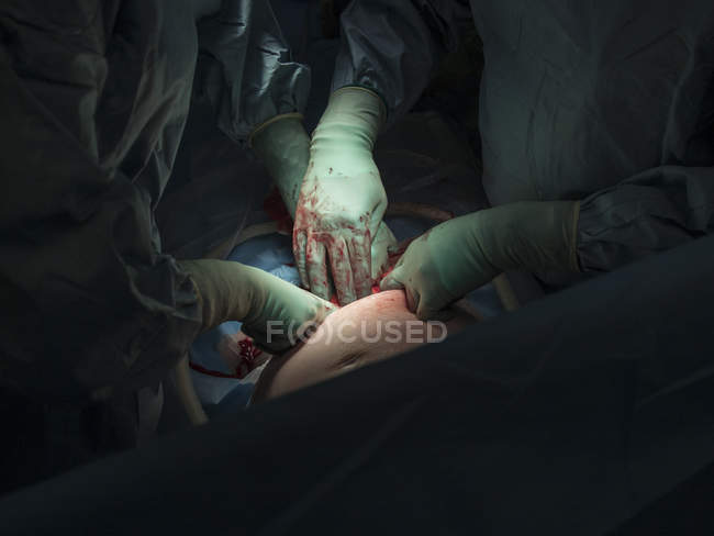 Хірурги виконують секцію кесаревого розтину — стокове фото