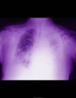 Closeup shot of x-ray of lung with mesothelioma — Stock Photo
