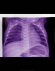Vista de cerca de la radiografía de gastroenteritis viral - foto de stock