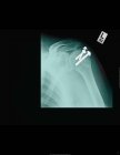 Closeup shot of x-ray showing shoulder screws — Stock Photo