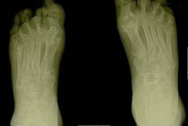 Nahaufnahme eines Röntgenbildes, das arthritische Füße zeigt — Stockfoto