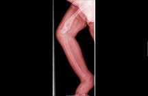 Close up view of x-ray of infant with leg fractures — Stock Photo