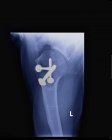 Крупним планом рентгенівський знімок, що показує плече з гвинтами — стокове фото