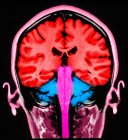Close-up tiro de RM seção sagital do cérebro normal — Fotografia de Stock