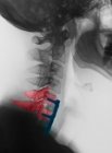Nahaufnahme einer Halswirbelsäulenröntgenaufnahme, die die Wirbelsäulenfusion zeigt — Stockfoto