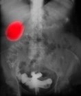 Closeup shot of x-ray showing so-called porcelain gallbladder — Stock Photo