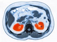 Visão de close-up de tomografia computadorizada de abdômen com pequena pedra renal — Fotografia de Stock