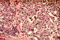Micrografía electrónica de barrido de células cancerosas de mama - foto de stock