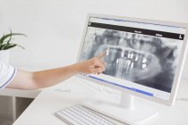 Person zeigt auf Röntgenbild auf Computerbildschirm — Stockfoto