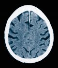 Gros plan de ct scan de vieux mâles atteints de la maladie d'Alzheimer — Photo de stock