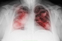 Primer plano de la radiografía de tórax de mujer madura fumadora - foto de stock