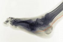 Raio-X do pé do diabético mostrando artéria calcificada — Fotografia de Stock
