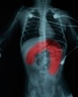 Nahaufnahme des Röntgenbildes des 11 Monate alten Kindes mit Darmverschluss — Stockfoto