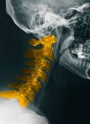 Vista da vicino della radiografia della colonna vertebrale cervicale dell'uomo adulto medio — Foto stock