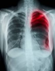 Cliché rapproché du pneumothorax spontané par radiographie pulmonaire — Photo de stock
