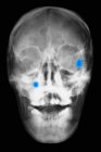Primo piano della radiografia della testa che mostra due proiettili nel cranio — Foto stock