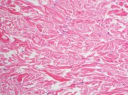 Scanning electron micrograph of abundant collagen in gardner fibroma — Stock Photo
