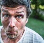 Portrait of man with black eye looking at camera pulling face — Stock Photo