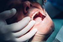 Стоматолог, який проводить стоматологічну процедуру на пацієнта чоловічої статі, крупним планом — стокове фото