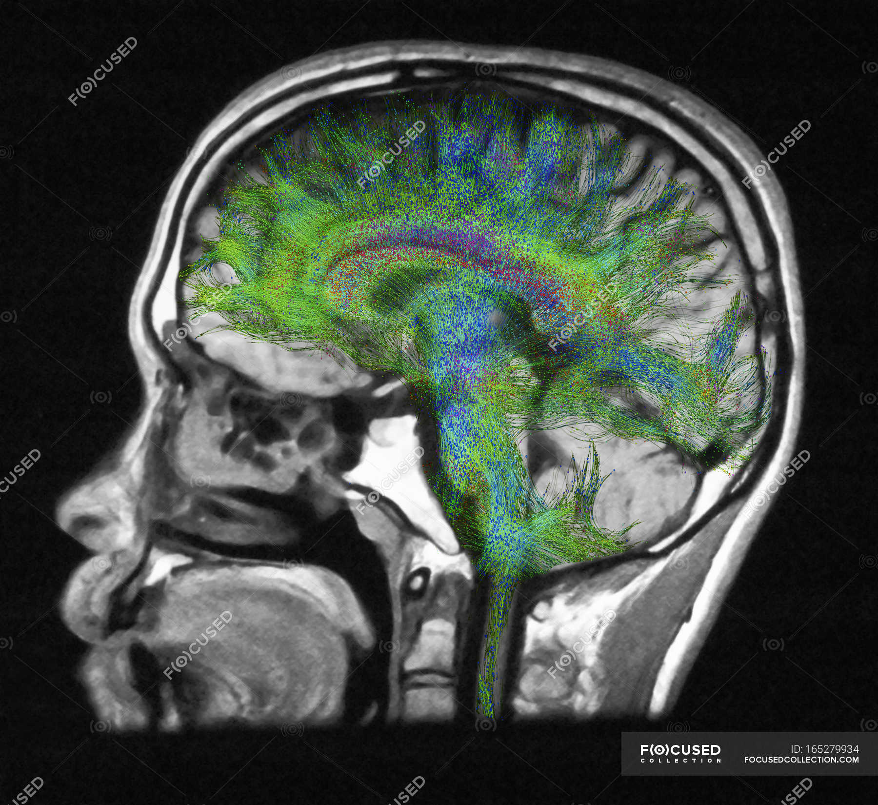 mri-brain-diffusion-weighted-sequences-dwi-two-weeks-later-with