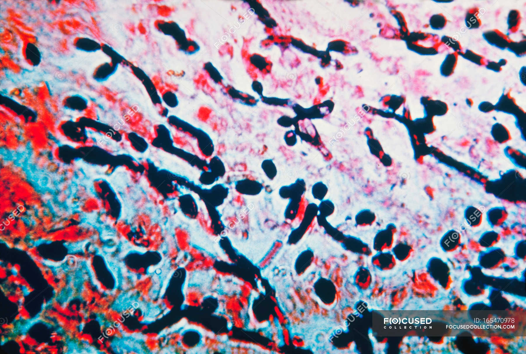 Light micrograph of Candida in esophagus mucosa — yeast, illness ...