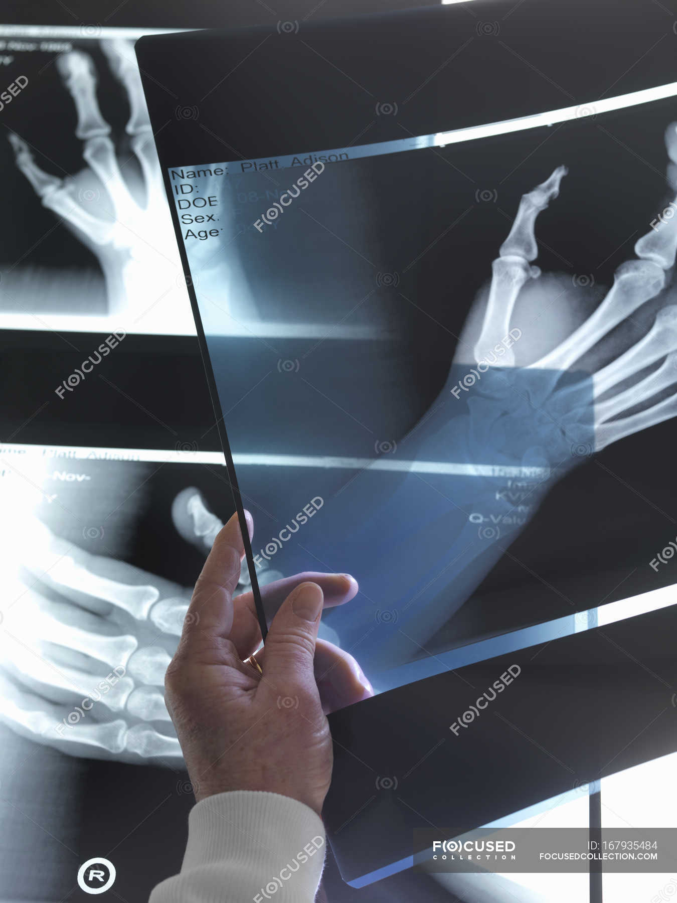 рентген руки фото