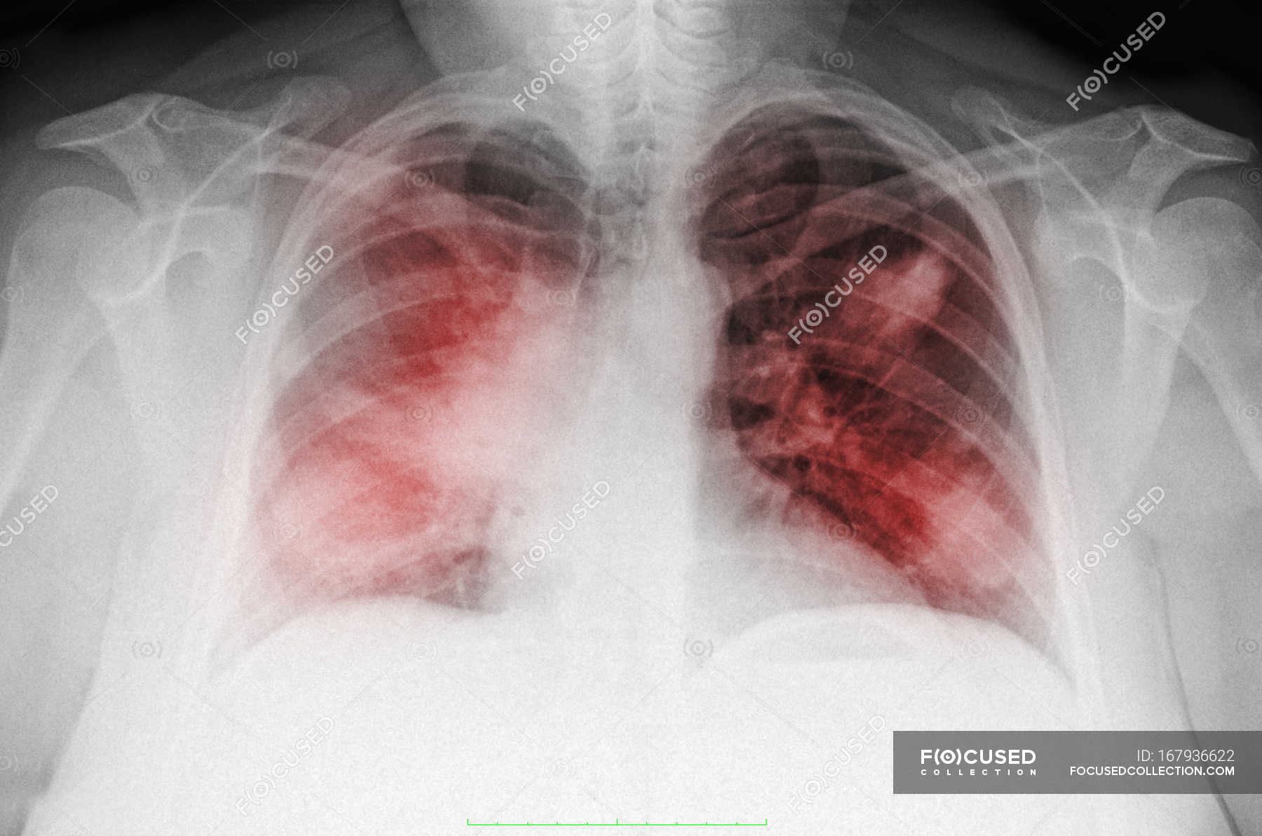 Closeup shot of chest x-ray of mature woman smoker — healthcare ...