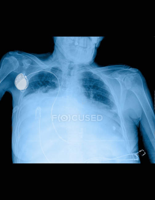 Крупним планом знімок рентгенівського знімка, що показує дисплей в грудях — стокове фото