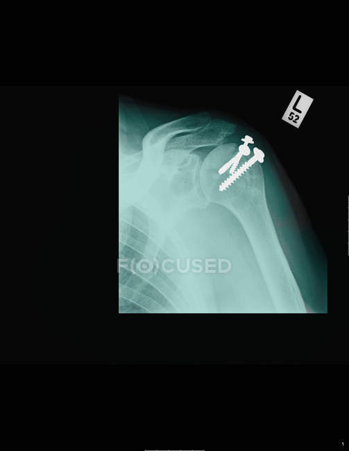 Closeup shot of x-ray showing shoulder screws — Stock Photo