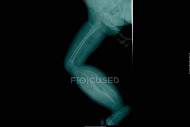 Visão de perto da radiografia de hiperostose cortical infantil — Fotografia de Stock