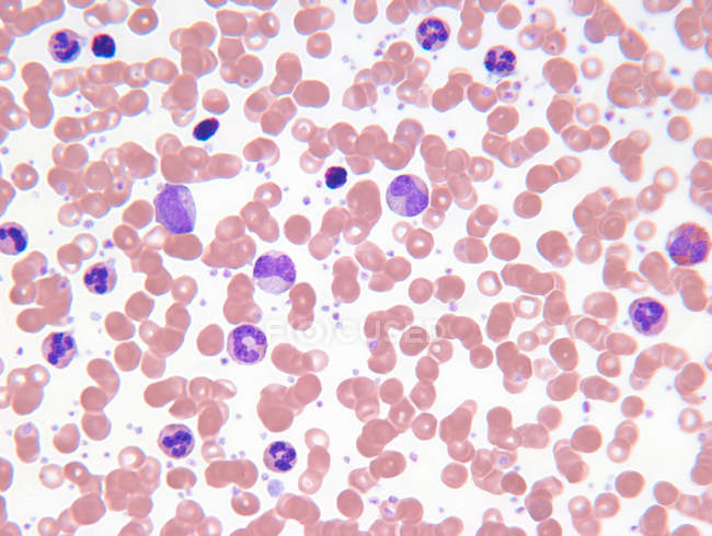 Scanning electron micrograph of  myelogenous leukemia — Stock Photo