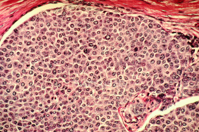 Tejido mamario con células cancerosas - foto de stock