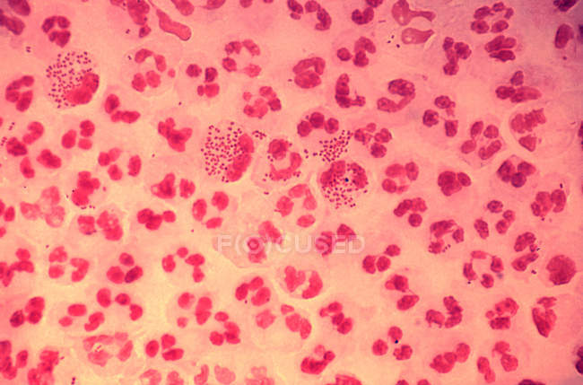 Micrografía electrónica de barrido de uretritis gonocócica - foto de stock