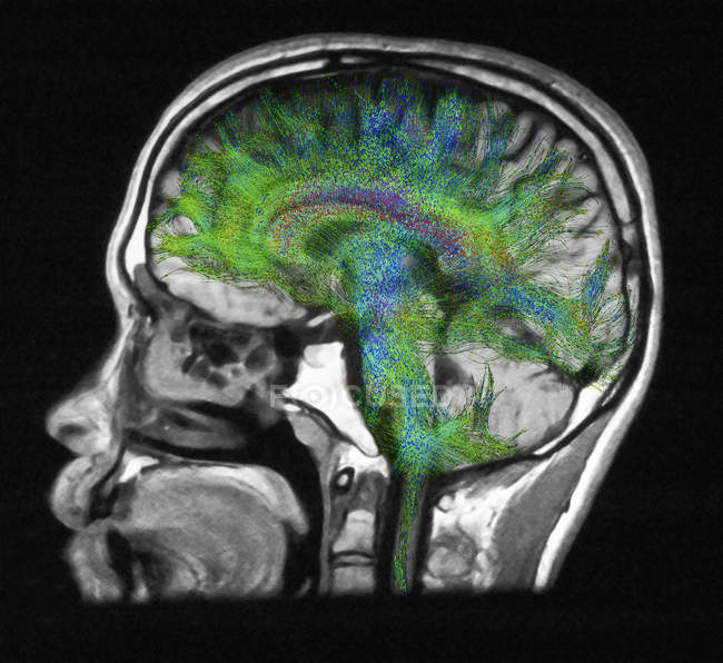Primo piano colpo di diffusione RM del cervello umano — Foto stock