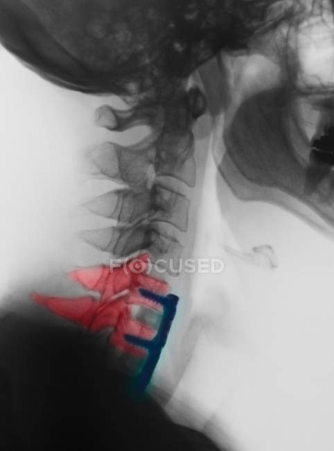 Nahaufnahme einer Halswirbelsäulenröntgenaufnahme, die die Wirbelsäulenfusion zeigt — Stockfoto