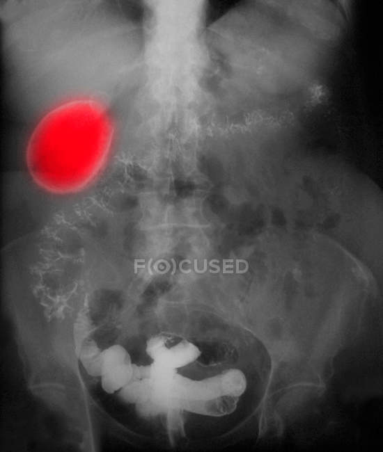 Крупним планом знімок рентгенівського зображення так званого порцелянового жовчного міхура — стокове фото