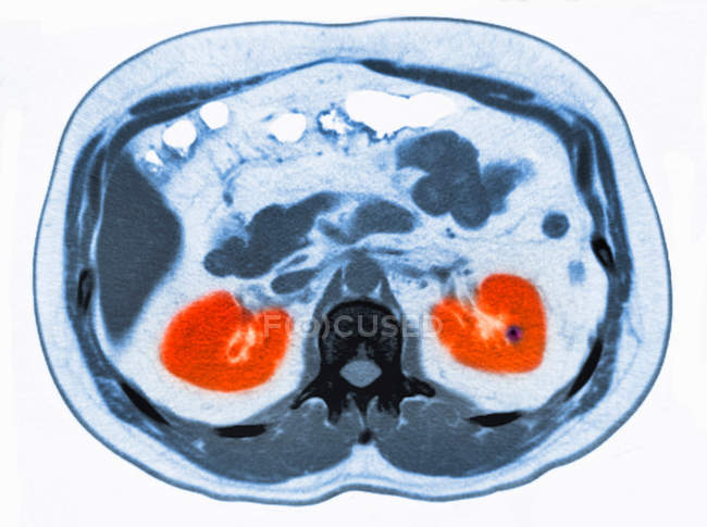 Vue rapprochée de ct scan de l'abdomen avec une petite pierre rénale — Photo de stock