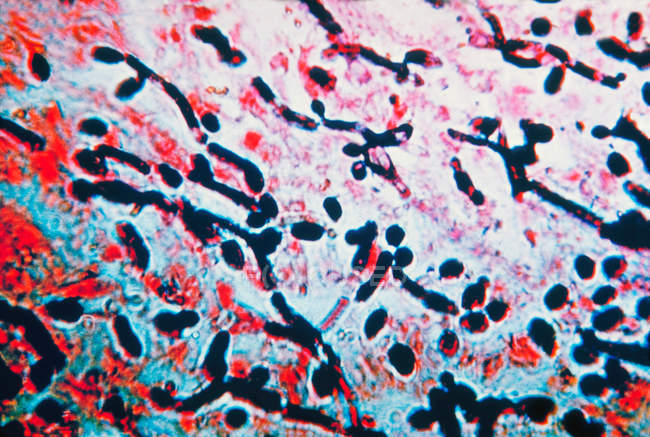 Световой микрограф Candida в слизистой оболочке пищевода — стоковое фото