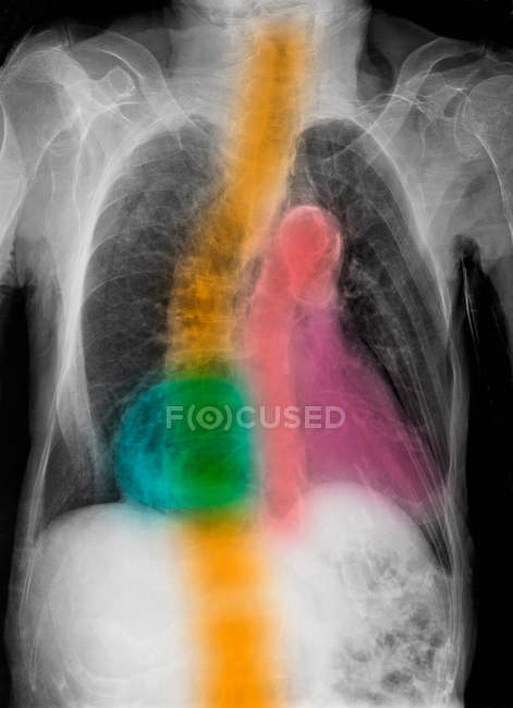 Gros plan de radiographie colorée de l'aorte et de la scoliose — Photo de stock