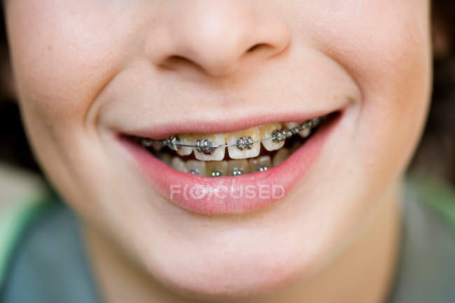 Primer plano de la boca del niño con el aparato ortopédico - foto de stock