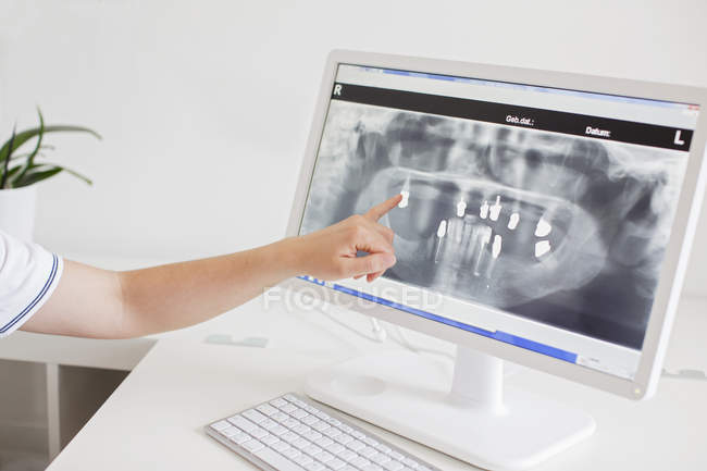 Persona que apunta a la imagen de rayos X en la pantalla del ordenador - foto de stock