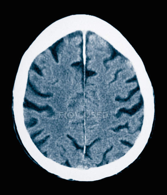 Close-up tiro de tomografia computadorizada de homem velho com doença de Alzheimers — Fotografia de Stock